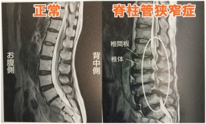 脊柱管狭窄症画像2